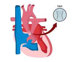 TAVI Procedure: Minimally Invasive Alternative to Open Heart Surgery